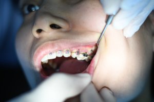 Tips to Save Money on Your Kid's Braces